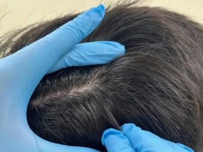 Tóc Sâu Nữ: Nguyên Nhân, Dấu Hiệu Nhận Biết và Cách Khắc Phục Hiệu Quả